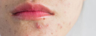 Zbliżenie na dolną część twarzy kobiety z widocznymi zmianami trądzikowymi. Skóra z wypryskami, widoczny trądzik.