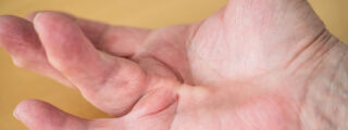 Przykurcz Dupuytrena na palcu serdecznym prawej ręki 76-letniej kobiety, widoczny na jej dłoni.